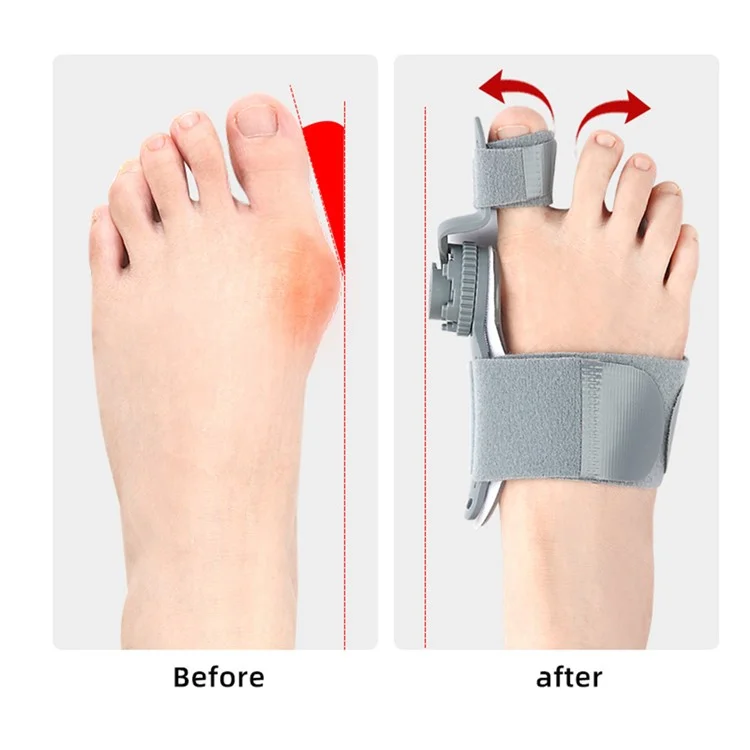 008 1 Stück Verstellbarer Hallux Valgus Korrektur Bandage Drehbarer Zehenspreizer Richter - Grau