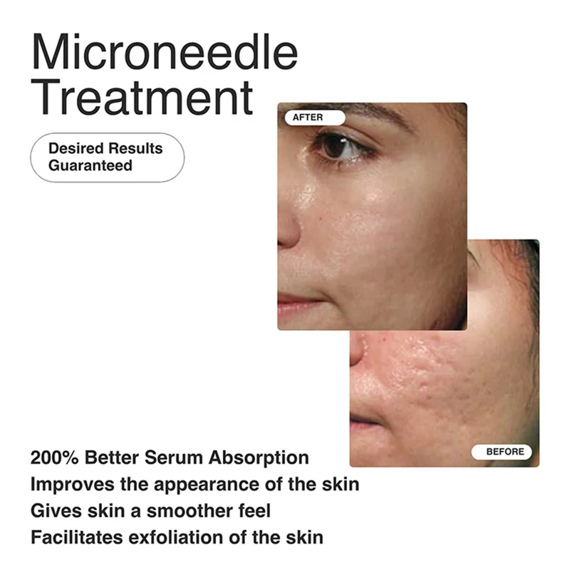 540 Micro Needles Titanium Microneedle Derma Roller Needle Skin Care Tool - 2.5mm