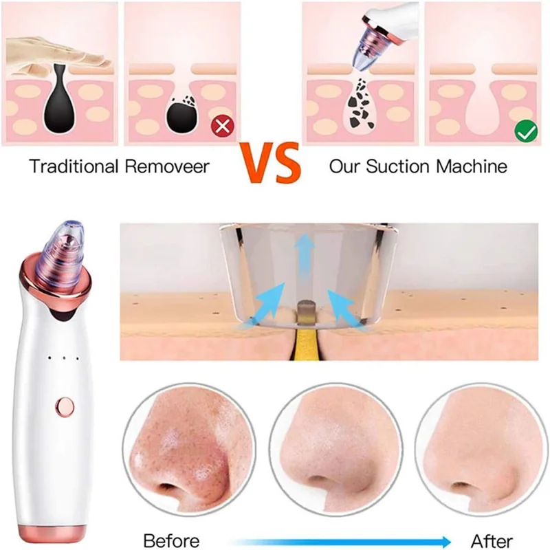 Blackhead Remover Pore Vacuum Cleaner with 5 Suction Heads and Pimple Needles Skin Care Tool Set