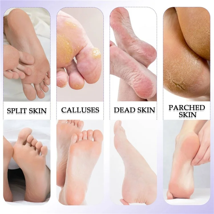 Conjunto de 8 peças de cuidados profissionais com os pés, removedor de calos e pele morta, lixa para os pés, ferramenta de remoção de calos.
