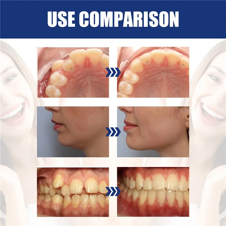 EELHOE EEA08-A105-1-MX1 Jaw Alignment Brace Orthodontic Appliance for Teeth Straightening Overbite Correction