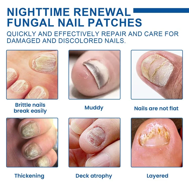 XIMONTH XIB05-A006-32-BU1 32Pcs Fungal Nail Patches Ingrown Toenail Overnight Repair Treatment