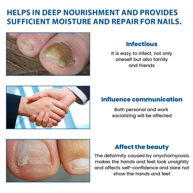 XIMONTH XIB05-A006-32-BU1 32Pcs Fungal Nail Patches Ingrown Toenail Overnight Repair Treatment