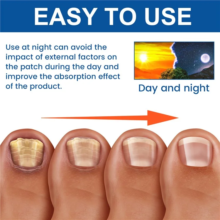 XIMONTH XIB05-A006-32-BU1 32Pcs Fungal Nail Patches Ingrown Toenail Overnight Repair Treatment