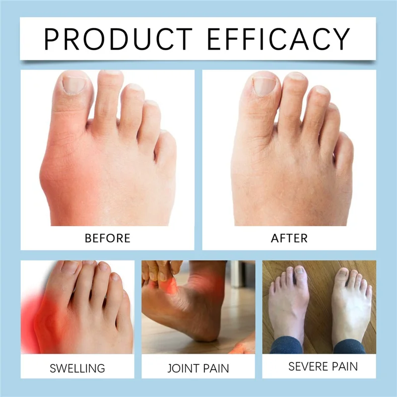 HOUKEA HK-B05-0044-01 Toe Care Separator Bunion Corrector Adjustable Comfortable Foot Support