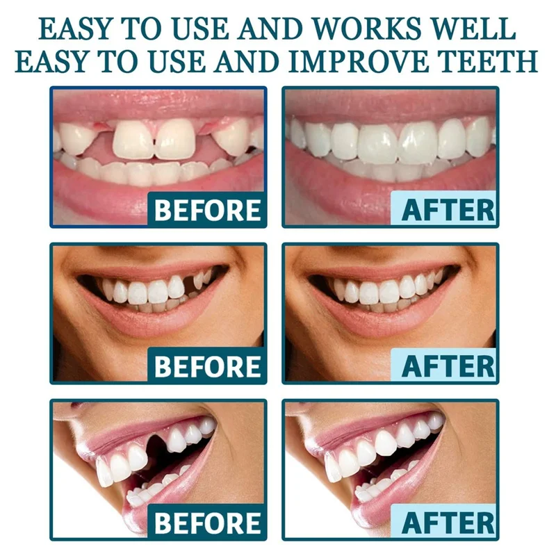 Kit de Carillas Dentales Ajustables EELHOE con Corrección Ortodoncia - Relleno de Espacios, EEA07-A016-1-WH1