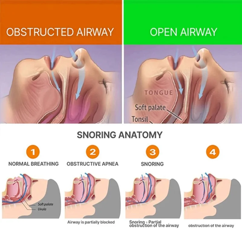 EELHOE Anti Snoring Mouthpiece Teeth Grinding Guard Sleep Aid Gift Easy Snore Stopper, EEA07-A036-1-WH1