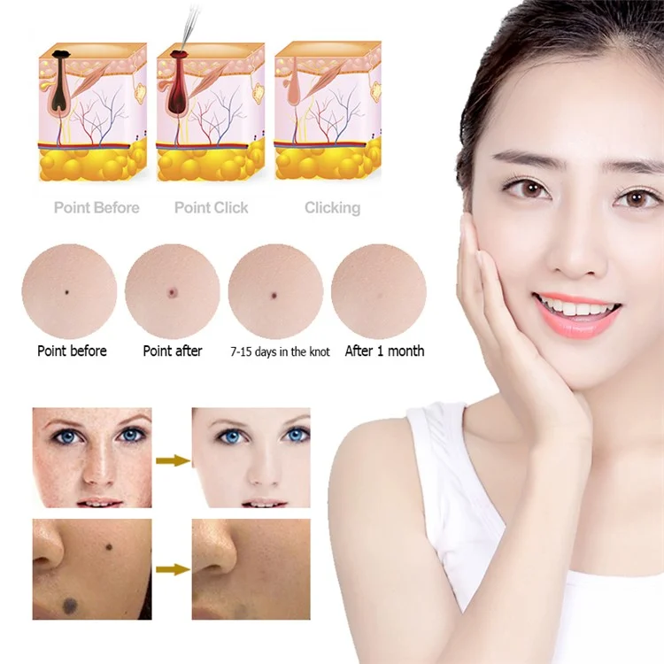 Laser Plasma Pen Mole Tattoo Freckle Wart Tag Removal Pen Dark Spot Remover for Face LCD Skin Care Tool - White