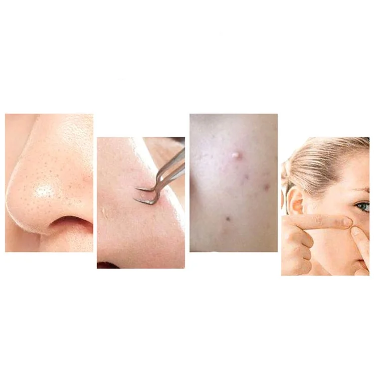 ES-1031 Blackhead Remover Household Vacuum Suction Pore Acne Blackhead Facial Cleanser Face Cleaning Device
