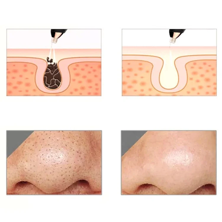 ES-1031 Blackhead Remover Household Vacuum Suction Pore Acne Blackhead Facial Cleanser Face Cleaning Device