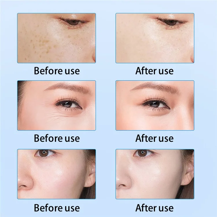 Máquina de radiofrecuencia facial para el levantamiento y remodelado corporal con tecnología bipolar de RF y EMS, con certificación CE (ST) - Enchufe europeo